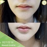 ฟิลเลอร์ ปากล่าง เชียงราย - คลินิกศัลยกรรม เชียงราย Chic Clinic