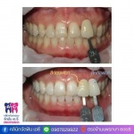 คลินิกฟอกฟันขาว สมุทรปราการ - คลินิกจัดฟัน เอ.ซี.
