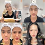 Filler รัชดา - บริษัท เคเจ คลินิก จำกัด