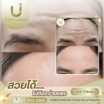 ฉีดโบลดริ้วรอย ชลบุรี - คลินิกเสริมความงาม บางแสน - ยูแอนด์ไอ คลินิก