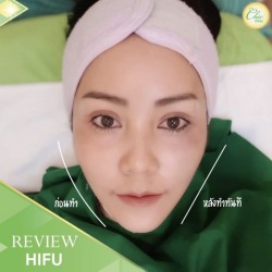 HIFU เชียงราย