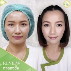 ทำตาสองชั้น เชียงราย