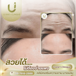 ฉีดโบลดริ้วรอย ชลบุรี