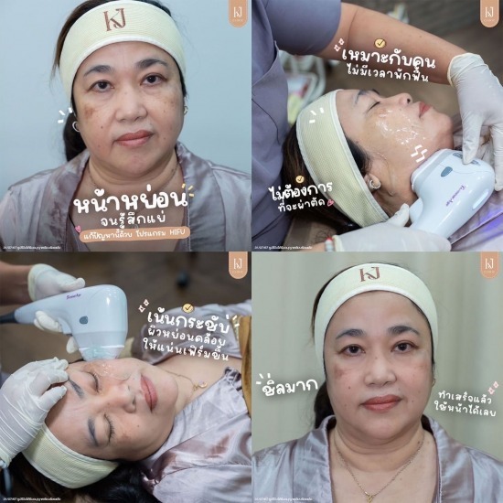 Hifu อินทามระ ฉีดโบท็อกรัชดา  ฉีดโบท็อกอินทามระ  Botox ราคาถูก  โปรแกรมหน้าใส รัชดา  โปรแกรมหน้าใส อินทามระ  รักษาฝ้า รัชดา  รักษาฝ้า อินทามระ  รักษาสิว รัชดา  วิตามินผิว รัชดา  เสริมจมูก รัชดา 