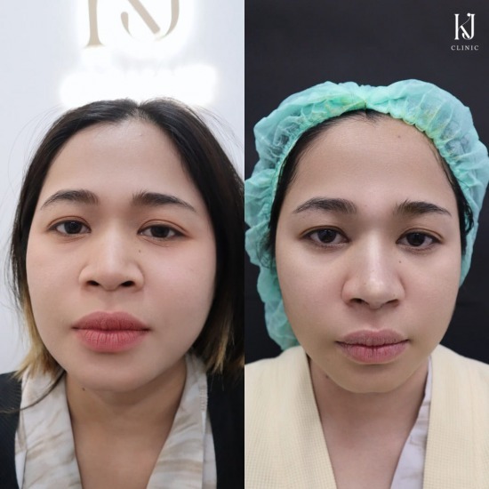 เสริมจมูก รัชดา ฉีดโบท็อกรัชดา  ฉีดโบท็อกอินทามระ  Botox ราคาถูก  โปรแกรมหน้าใส รัชดา  โปรแกรมหน้าใส อินทามระ  รักษาฝ้า รัชดา  รักษาฝ้า อินทามระ  รักษาสิว รัชดา  วิตามินผิว รัชดา  เสริมจมูก รัชดา 